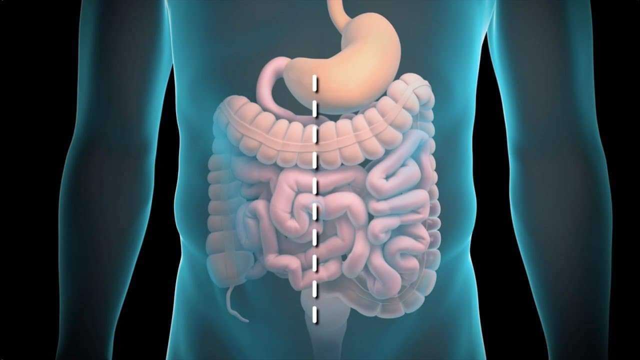rezecție intestinală puzzle online