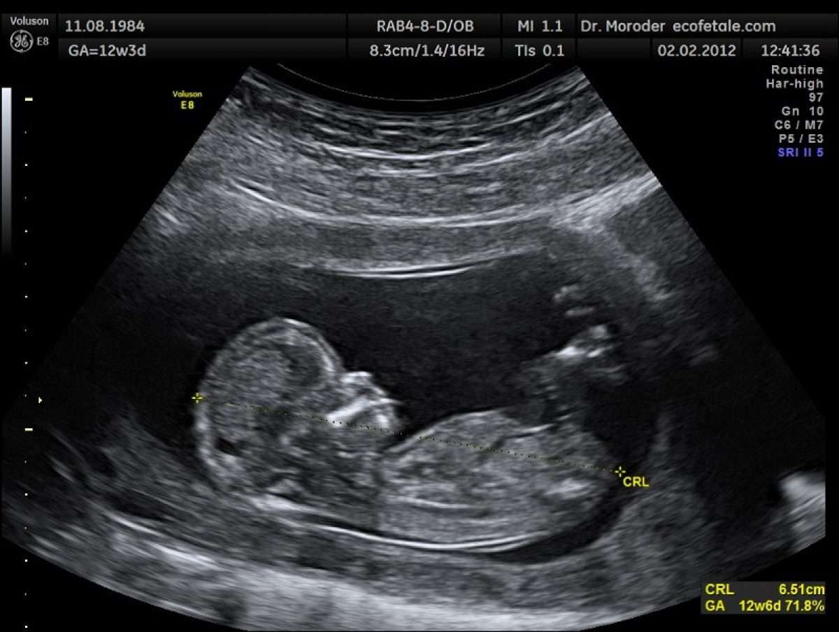 baby ultraljud Pussel online
