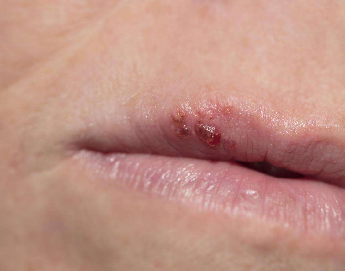 herpes labial puzzle online