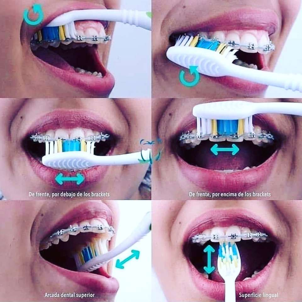 Ортодонтическая техника чистки зубов онлайн-пазл