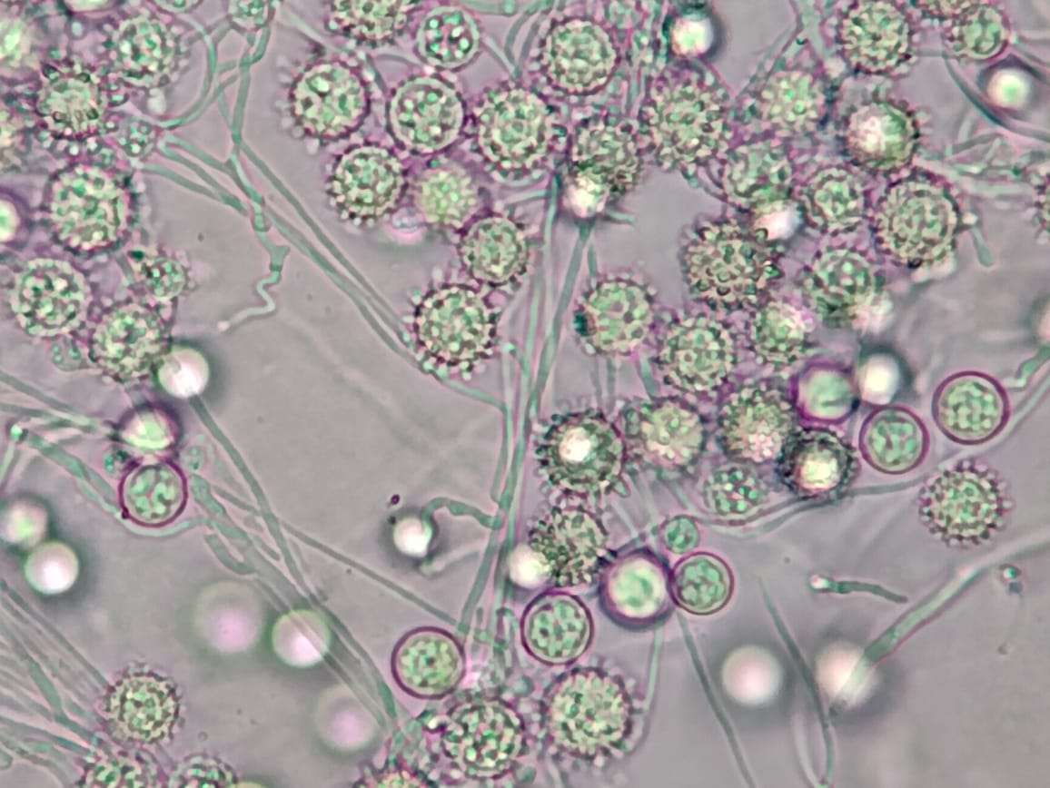 Histoplasmosis (Hongos) rompecabezas en línea