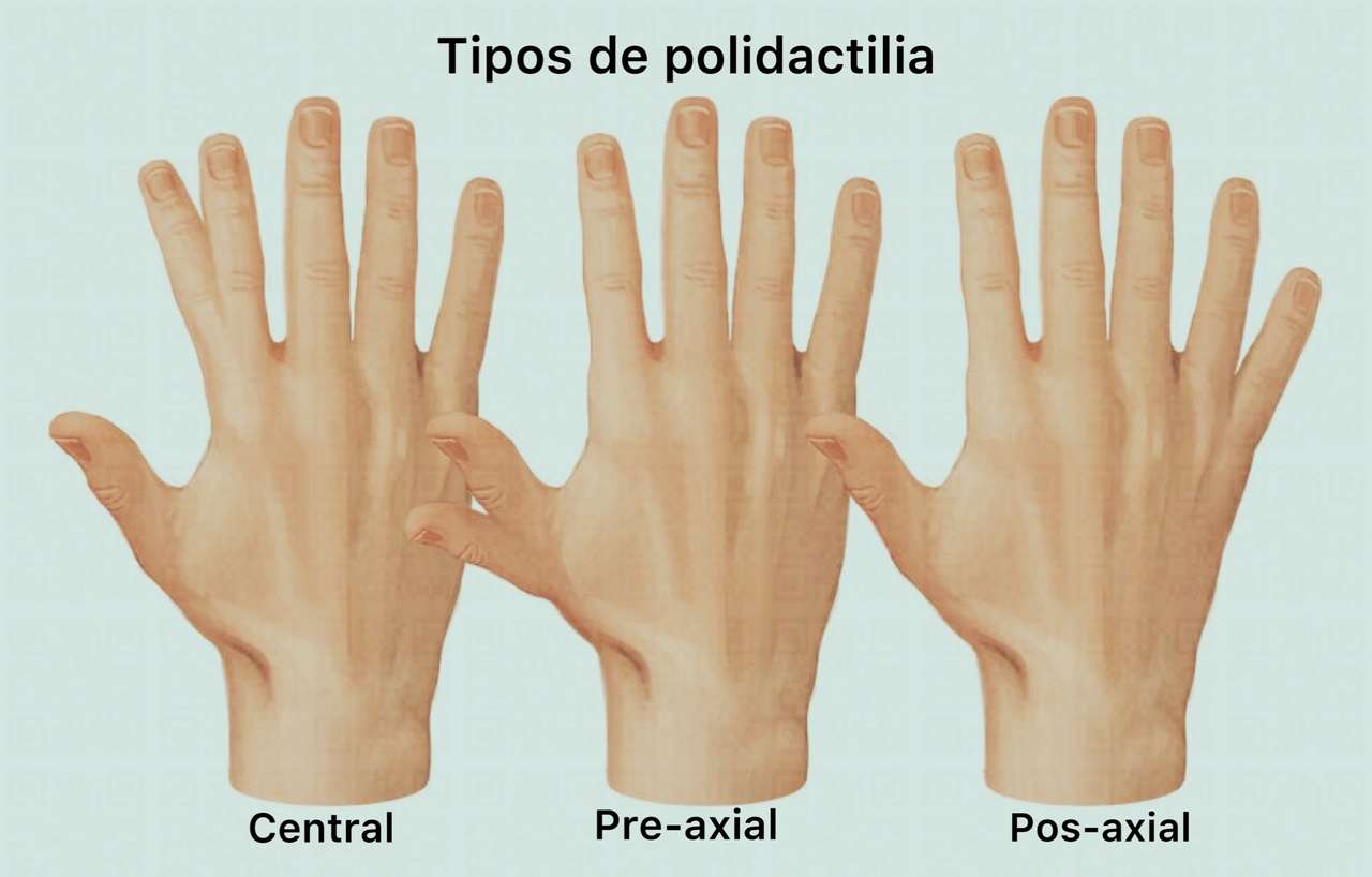 Polidactilia rompecabezas en línea