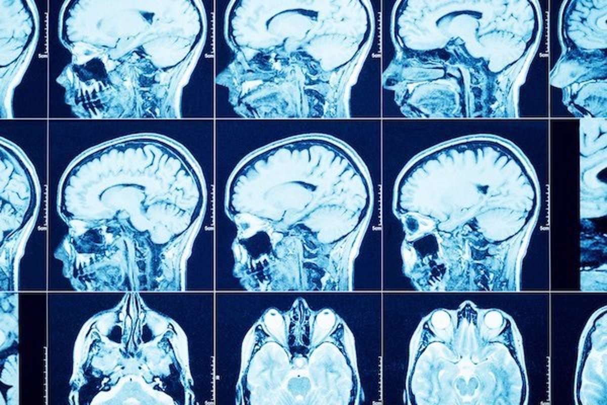 Mozkové nádory, infekce a epilepsie skládačky online