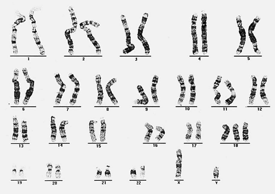 Edwar-Syndrom-Rätsel Online-Puzzle