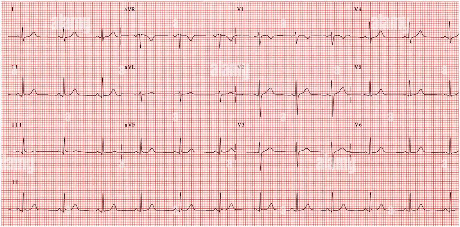 EKG patológico o normal online puzzle