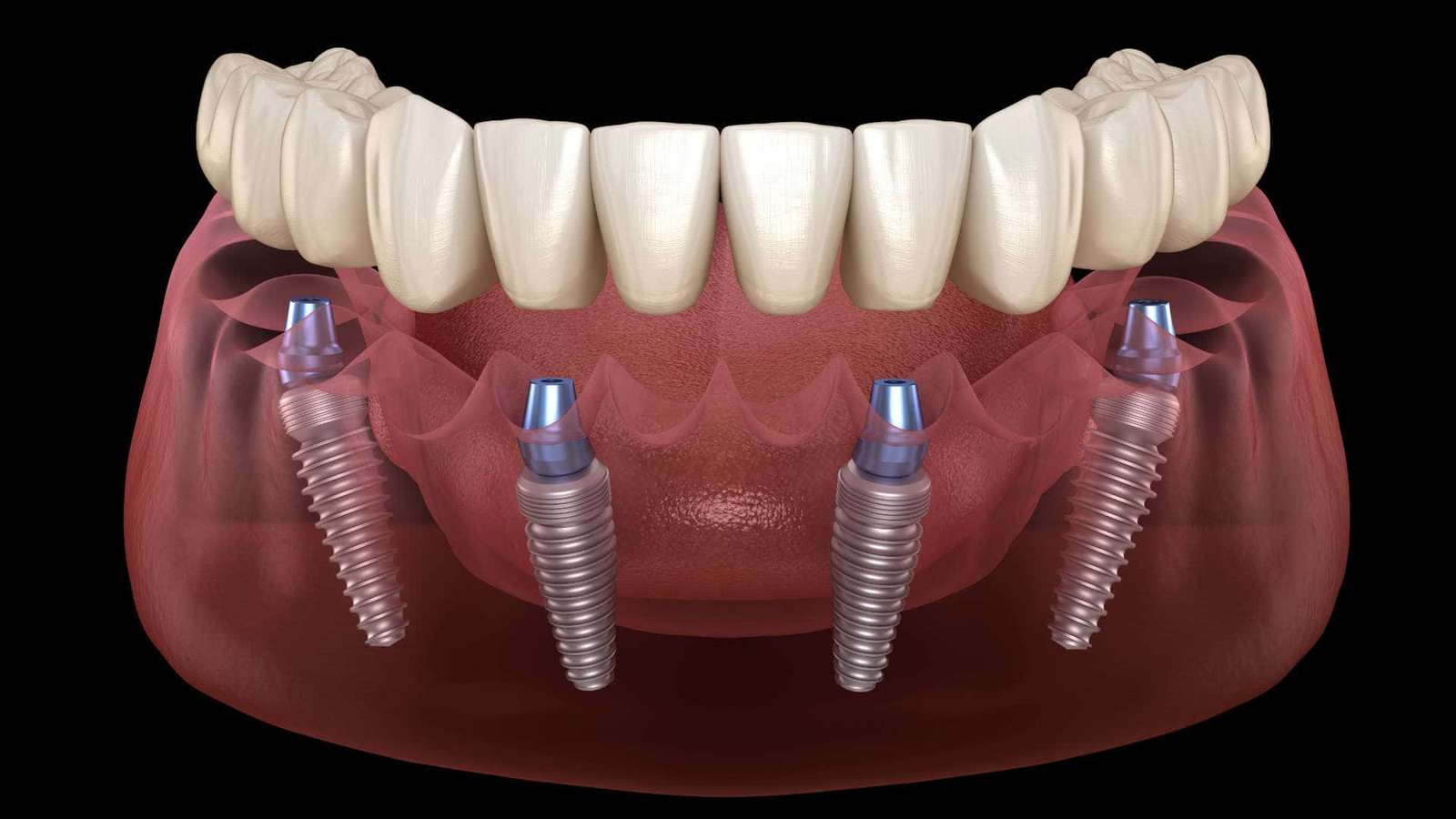 travail d'implant puzzle en ligne