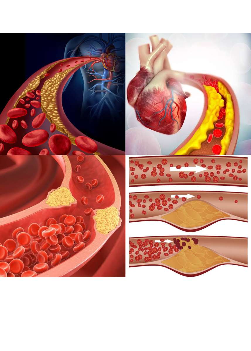 Cholesterol puzzle online